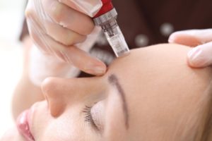 medical microneedling bremen behandlung