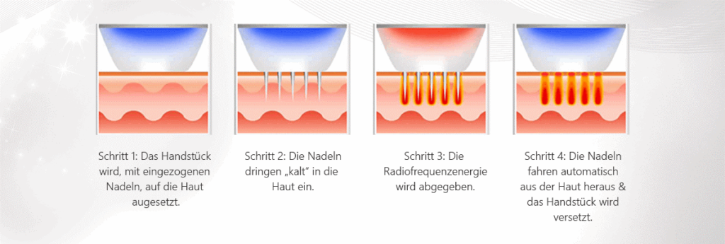 Microneedling Münster Verfahren