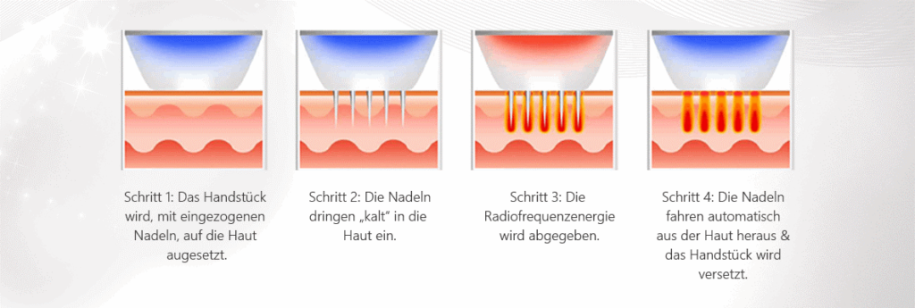 microneedling-oldenburg-verfahren Microneedling Oldenburg Verfahren