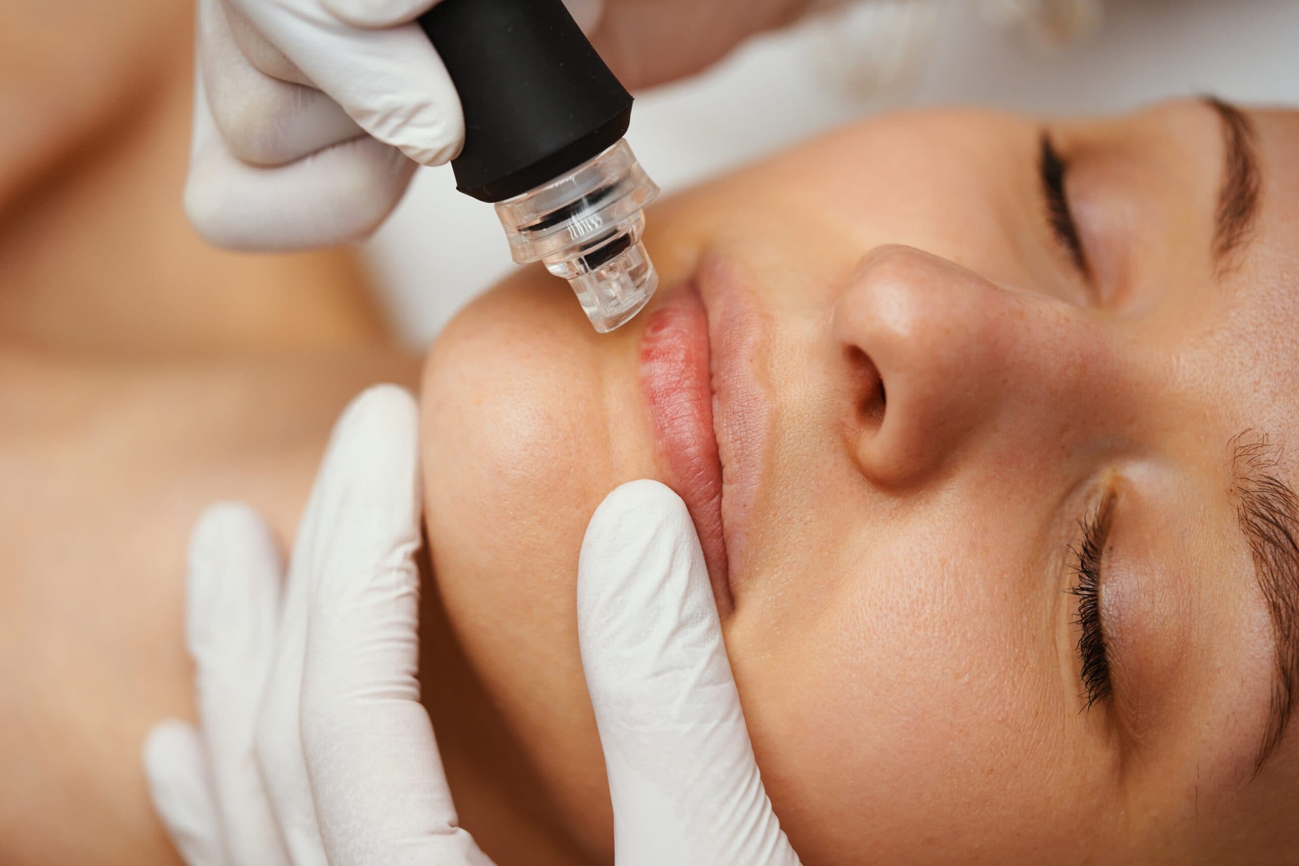 Medical Microneedling Kosmetikstudio Bremen